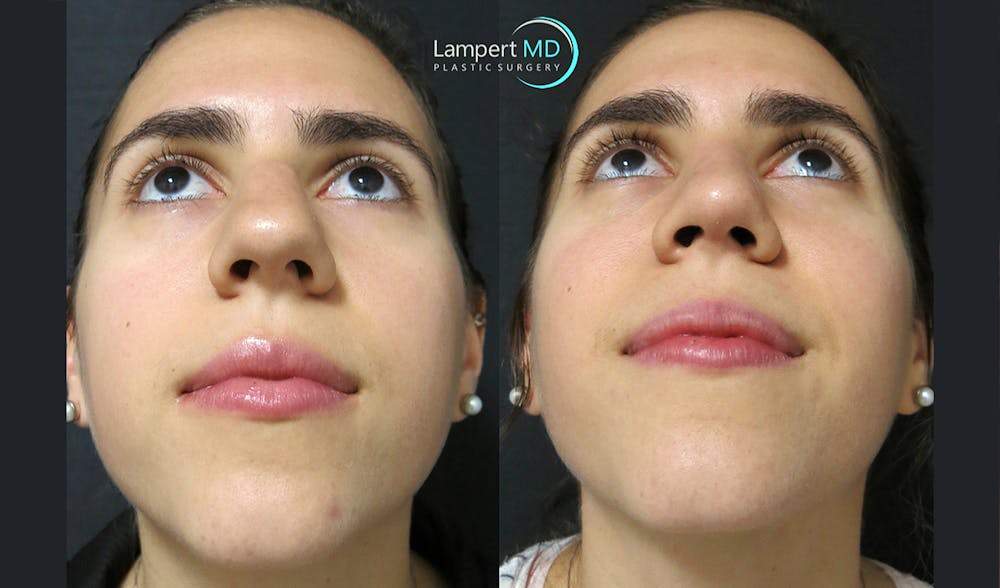 Rhinoplasty Before & After Gallery - Patient 123816076 - Image 5