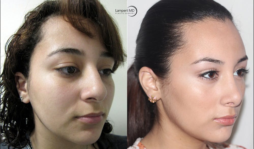 Rhinoplasty Before & After Gallery - Patient 123816077 - Image 1