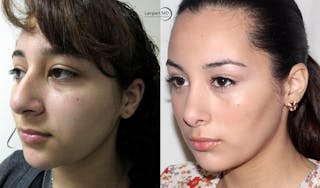 Rhinoplasty Before & After Gallery - Patient 123816077 - Image 2