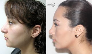 Rhinoplasty Before & After Gallery - Patient 123816077 - Image 3