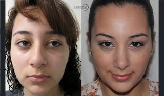 Rhinoplasty Before & After Gallery - Patient 123816077 - Image 4