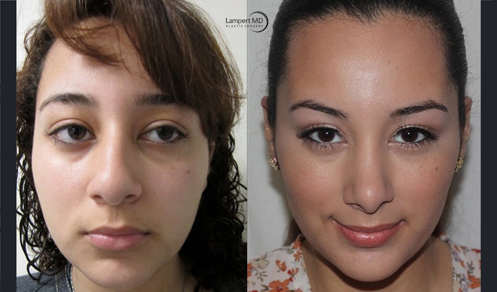 Rhinoplasty Before & After Gallery - Patient 123816077 - Image 4