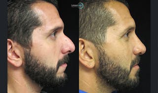Nasal Fracture Before & After Gallery - Patient 144711766 - Image 3
