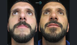 Rhinoplasty Before & After Gallery - Patient 123816081 - Image 3
