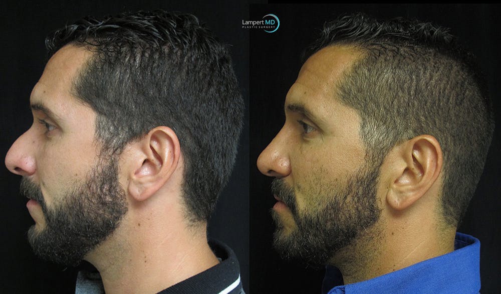 Rhinoplasty Before & After Gallery - Patient 123816081 - Image 4