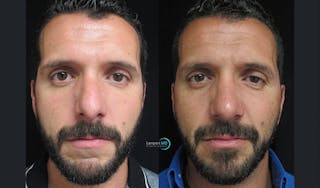 Nasal Fracture Before & After Gallery - Patient 144711766 - Image 1