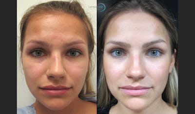 Rhinoplasty Before & After Gallery - Patient 123816082 - Image 1