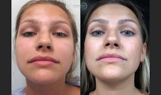Rhinoplasty Before & After Gallery - Patient 123816082 - Image 2