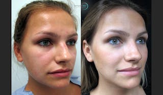 Rhinoplasty Before & After Gallery - Patient 123816082 - Image 3