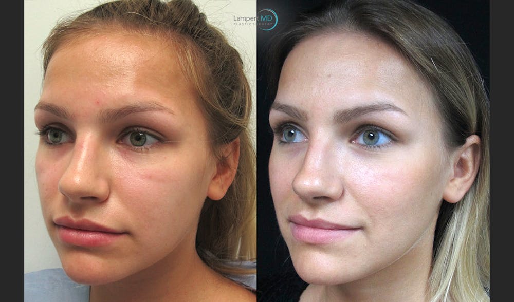 Rhinoplasty Before & After Gallery - Patient 123816082 - Image 4