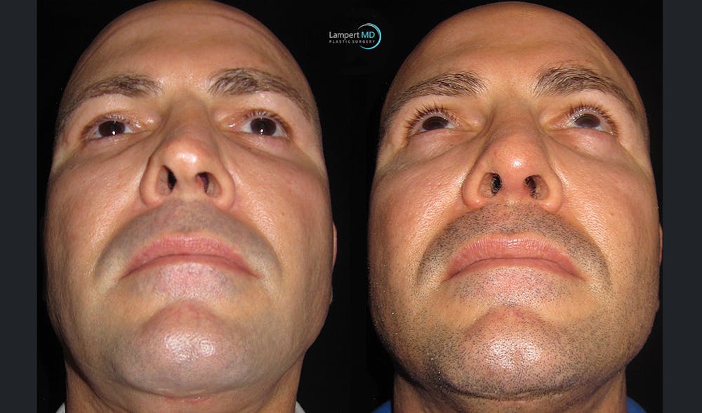 Rhinoplasty Before & After Gallery - Patient 123816089 - Image 1