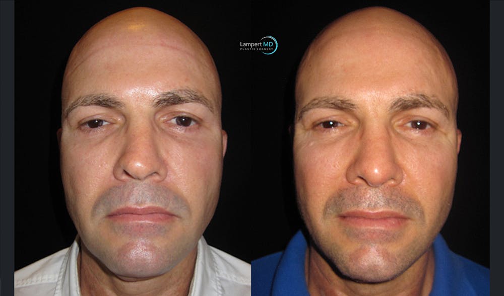 Rhinoplasty Before & After Gallery - Patient 123816089 - Image 2