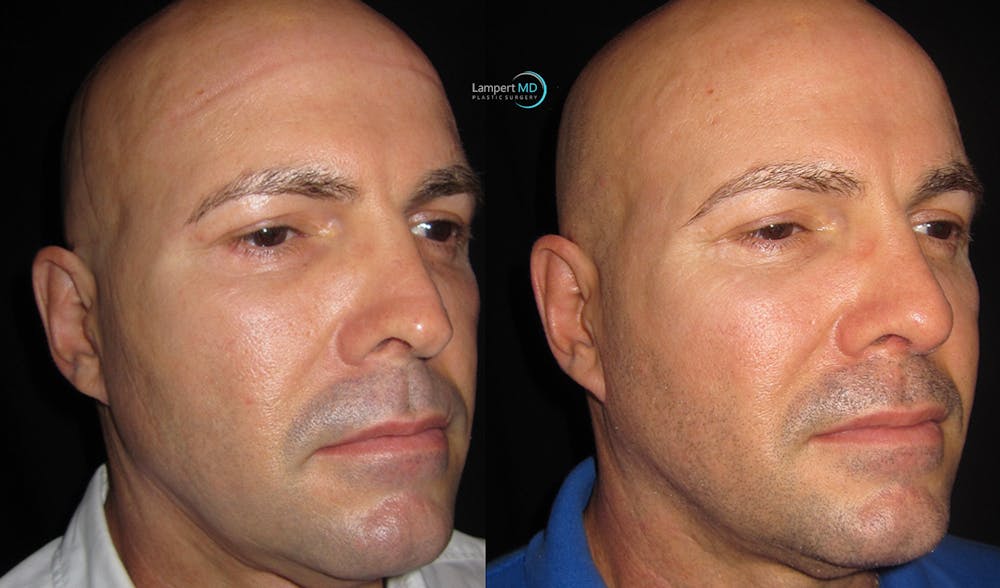 Rhinoplasty Before & After Gallery - Patient 123816089 - Image 3