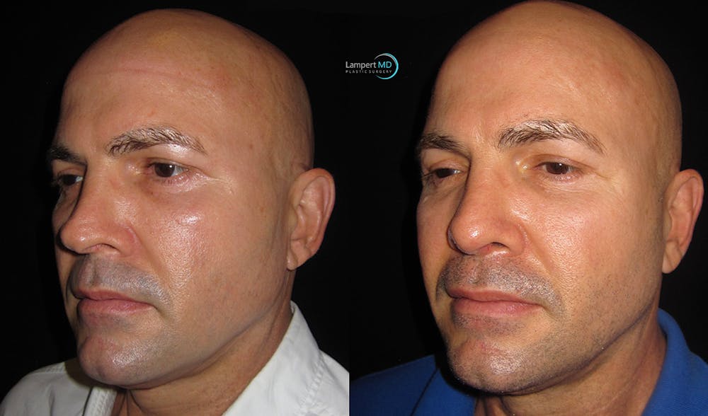 Nasal Fracture Before & After Gallery - Patient 144711772 - Image 4