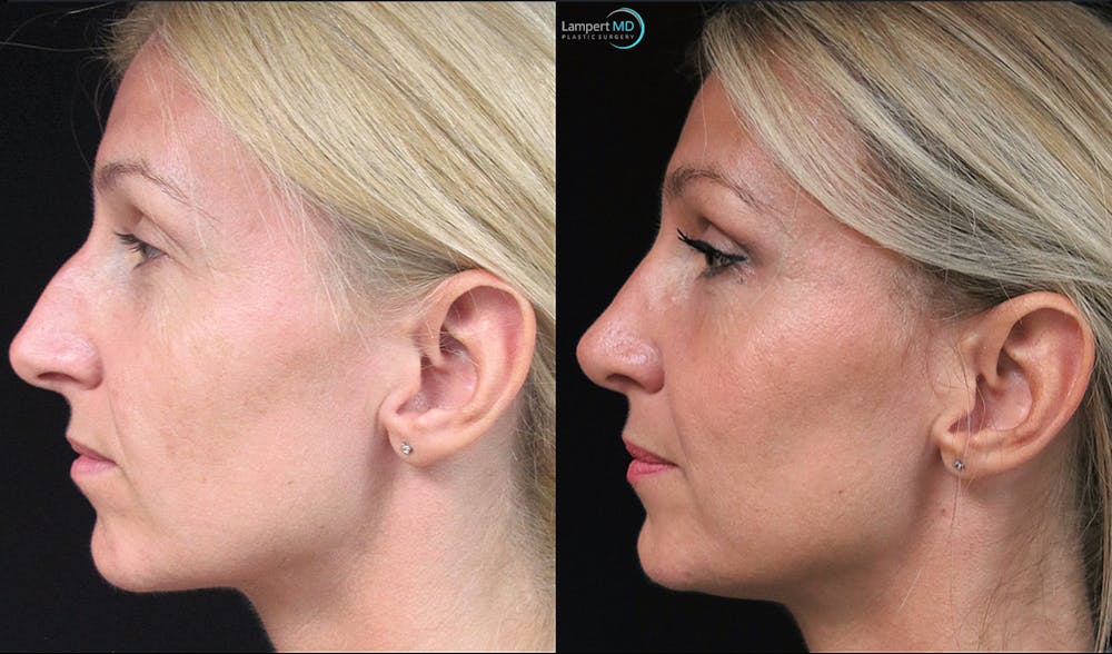 Rhinoplasty Before & After Gallery - Patient 123816092 - Image 1