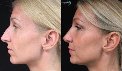 Rhinoplasty Before & After Gallery - Patient 123816092 - Image 1