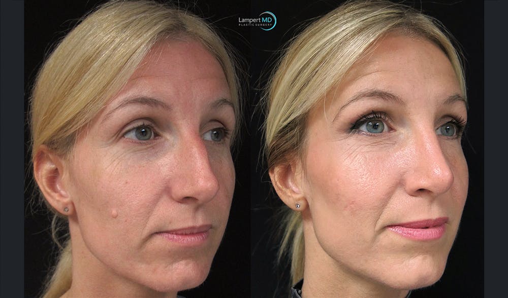 Rhinoplasty Before & After Gallery - Patient 123816092 - Image 2