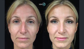 Rhinoplasty Before & After Gallery - Patient 123816092 - Image 3