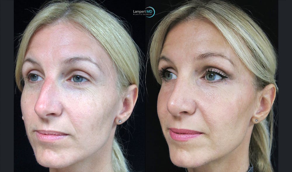 Rhinoplasty Before & After Gallery - Patient 123816092 - Image 4