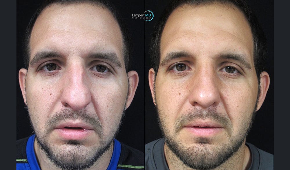Rhinoplasty Before & After Gallery - Patient 123816112 - Image 1