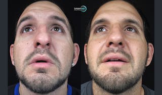 Nasal Fracture Before & After Gallery - Patient 122908648 - Image 2