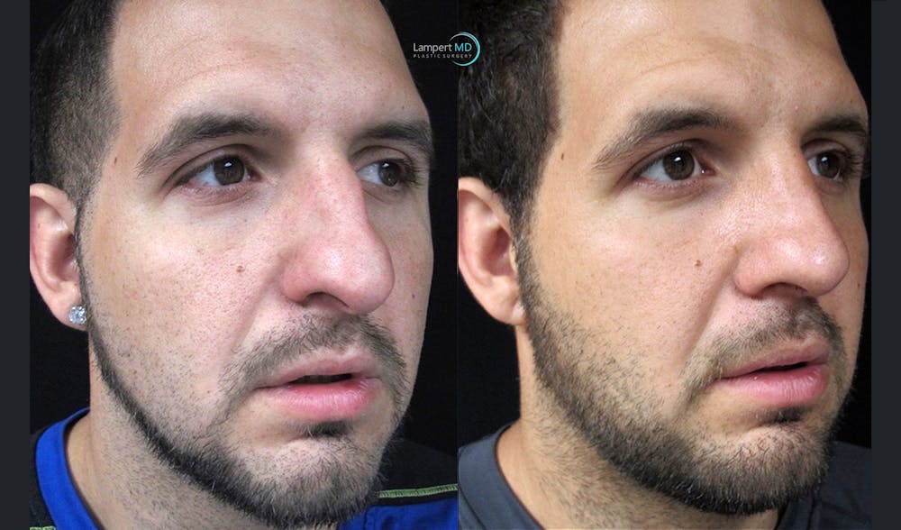 Rhinoplasty Before & After Gallery - Patient 123816112 - Image 3