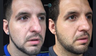 Nasal Fracture Before & After Gallery - Patient 122908648 - Image 3