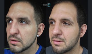 Rhinoplasty Before & After Gallery - Patient 123816112 - Image 4