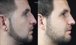 Nasal Fracture Before & After Gallery - Patient 122908648 - Image 4