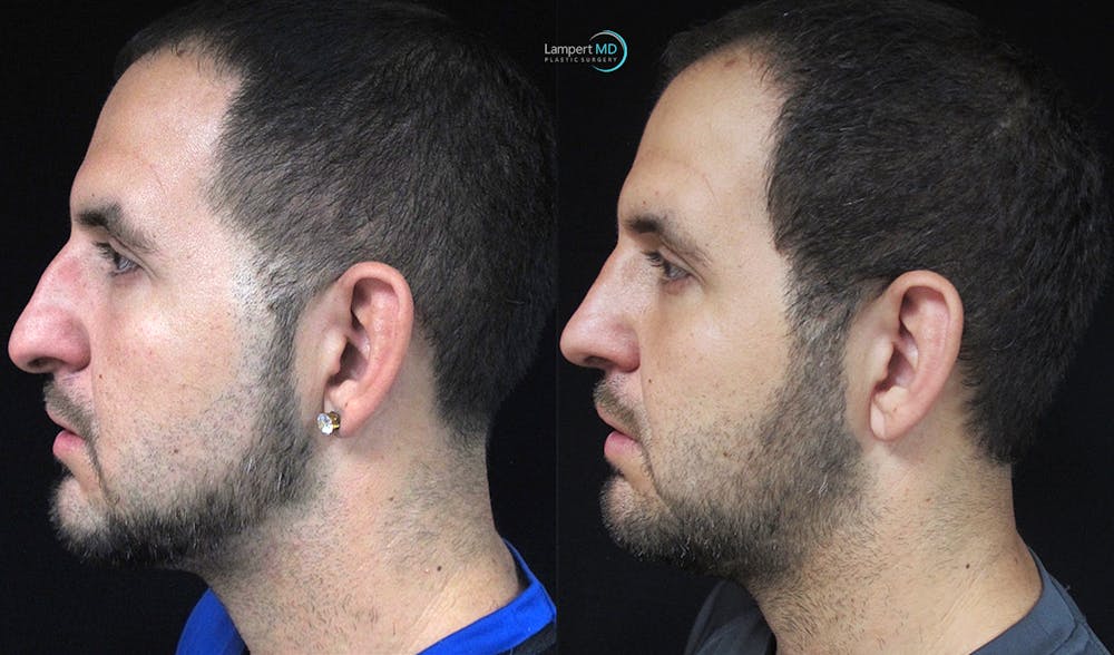 Rhinoplasty Before & After Gallery - Patient 123816112 - Image 6