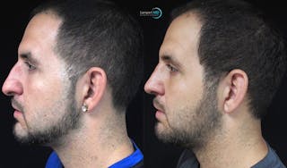 Nasal Fracture Before & After Gallery - Patient 122908648 - Image 6