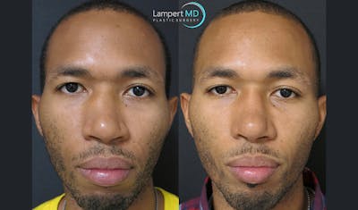 Rhinoplasty Before & After Gallery - Patient 123816115 - Image 1