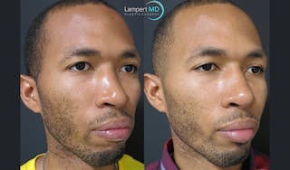 Nasal Fracture Before & After Gallery - Patient 122908680 - Image 2