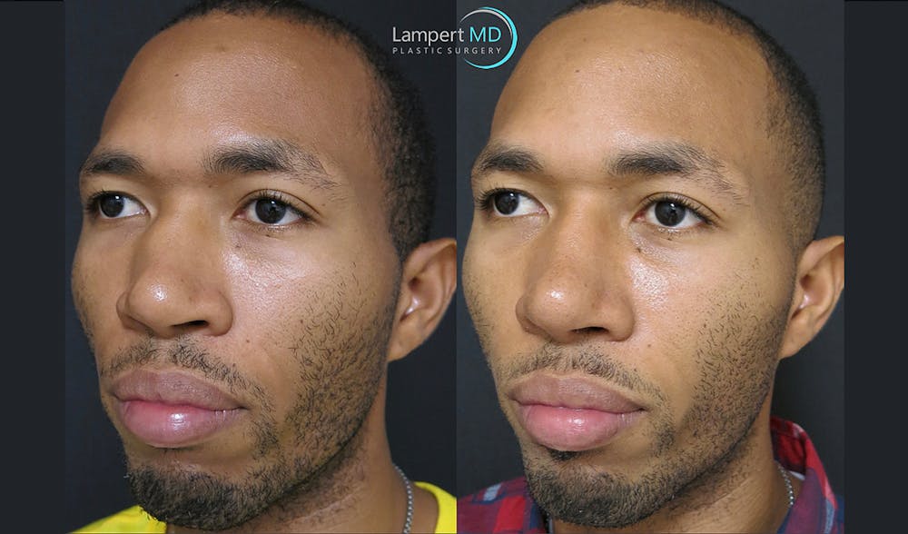Rhinoplasty Before & After Gallery - Patient 123816115 - Image 3