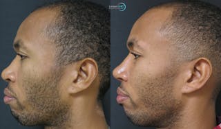 Nasal Fracture Before & After Gallery - Patient 122908680 - Image 4