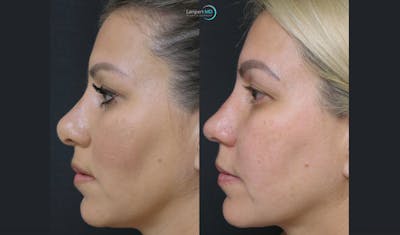 Rhinoplasty Before & After Gallery - Patient 123816118 - Image 1
