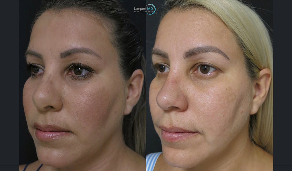 Rhinoplasty Before & After Gallery - Patient 123816118 - Image 2