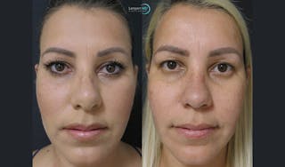 Rhinoplasty Before & After Gallery - Patient 123816118 - Image 3
