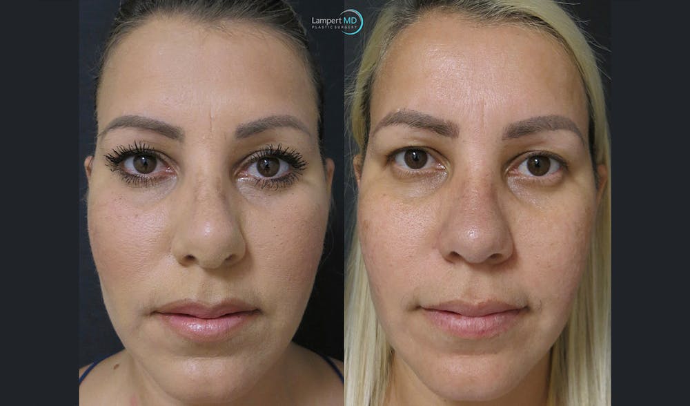 Rhinoplasty Before & After Gallery - Patient 123816118 - Image 3