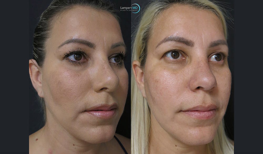 Rhinoplasty Before & After Gallery - Patient 123816118 - Image 4