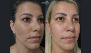 Rhinoplasty Before & After Gallery - Patient 123816118 - Image 4