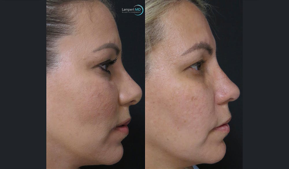 Rhinoplasty Before & After Gallery - Patient 123816118 - Image 5