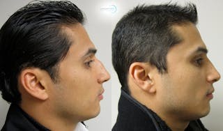 Nasal Fracture Before & After Gallery - Patient 144711786 - Image 3