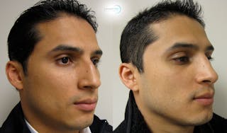 Rhinoplasty Before & After Gallery - Patient 123816122 - Image 2