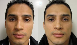 Rhinoplasty Before & After Gallery - Patient 123816122 - Image 3