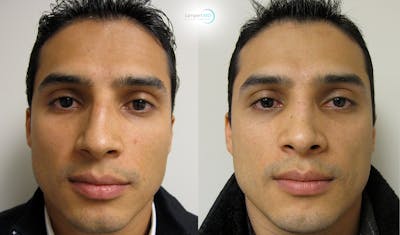 Nasal Fracture Before & After Gallery - Patient 144711786 - Image 1