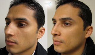 Nasal Fracture Before & After Gallery - Patient 144711786 - Image 4