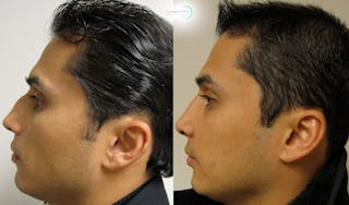 Nasal Fracture Before & After Gallery - Patient 144711786 - Image 5