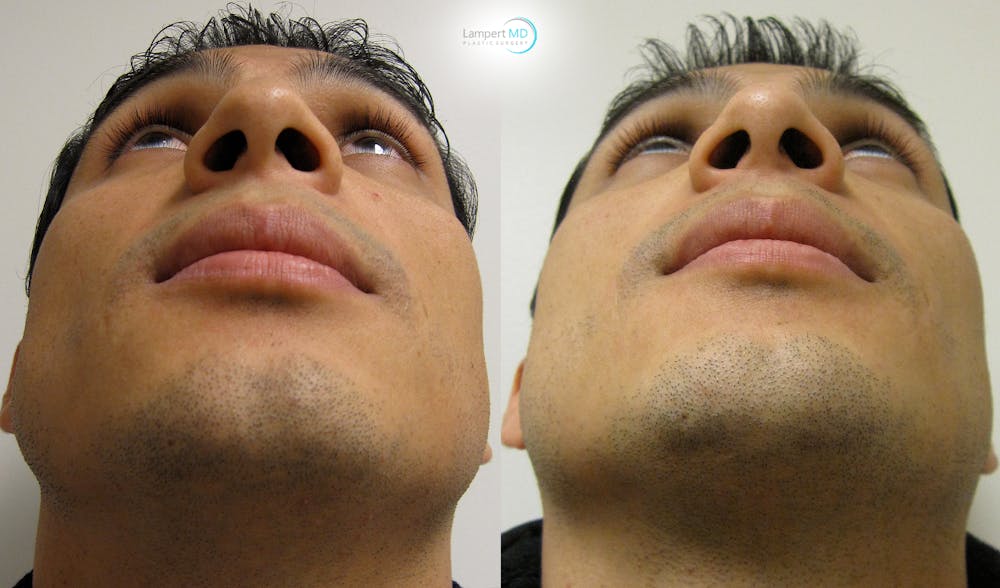 Nasal Fracture Before & After Gallery - Patient 144711786 - Image 6