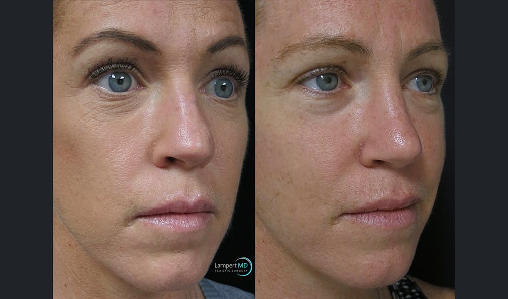 Rhinoplasty Before & After Gallery - Patient 123816179 - Image 1